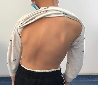 Skoljożi Screening u Ġestjoni: Kif Xianku 3D Body Scanner Jgħin lill-kiroprattiċi