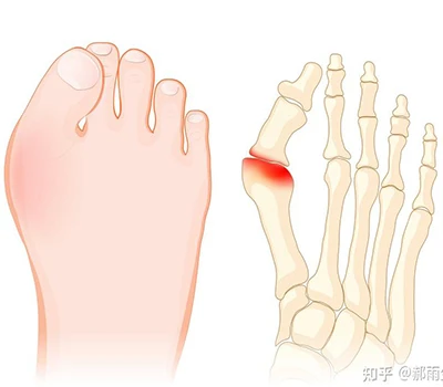 Hallux Valgus: Gwida Sħiħa tax-Xjenza
