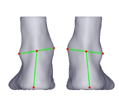 Heel Valgus u Varus: theddida siekta madwar