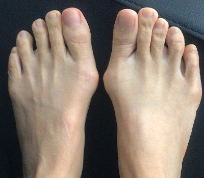 Il-Kejl tal-Hallux Valgus: Għaliex l-iskanners 3D qed jaqbżu l-kliniċisti u l-isptarijiet
